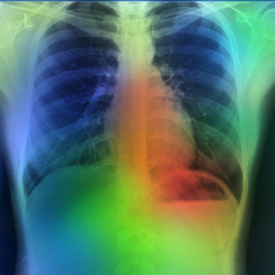 Image for Lung cancer screening can pave the way for COVID-19 recovery