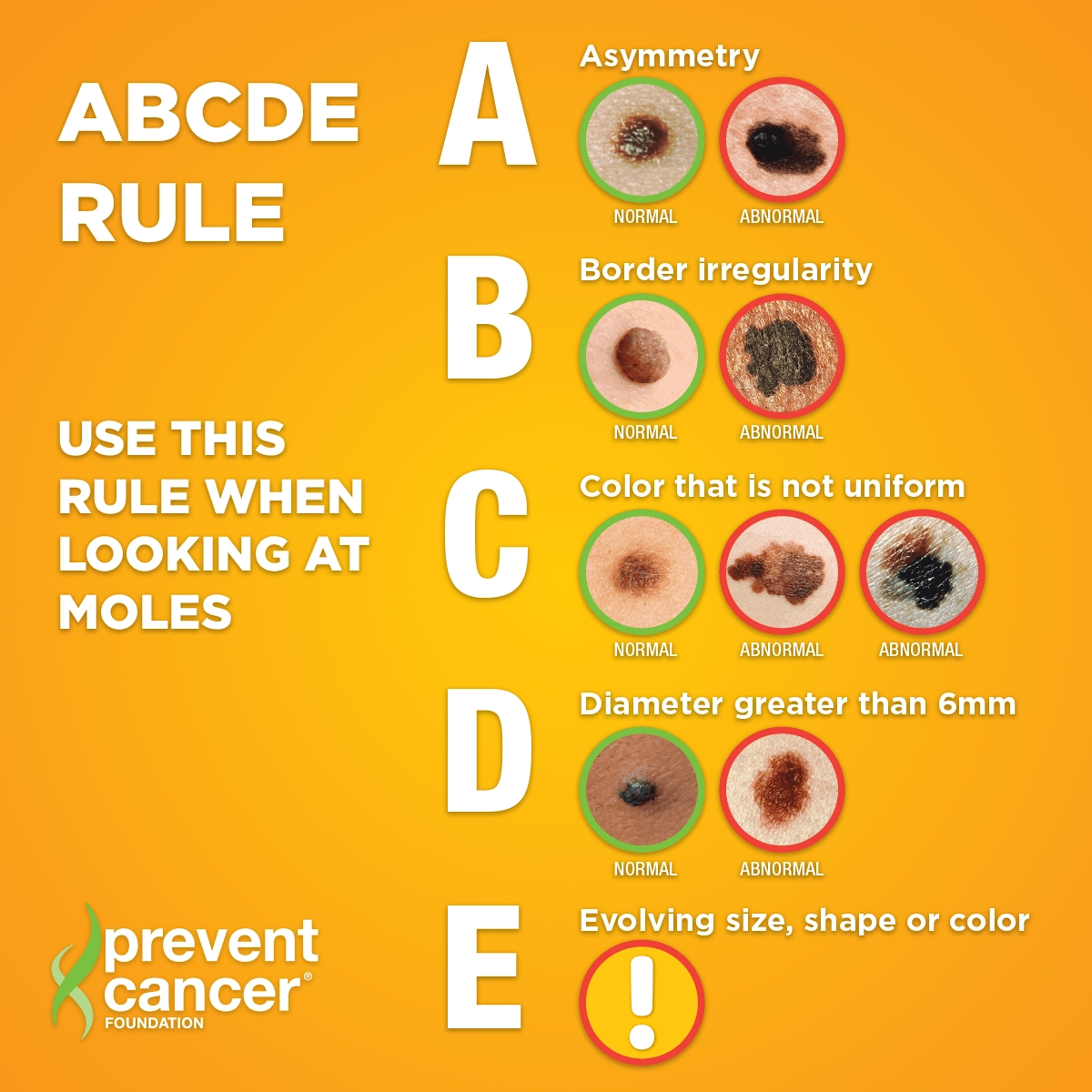 Skin Cancer Additional Asset – ABCED Rule