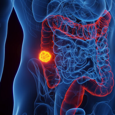 Image for Statement from the Prevent Cancer Foundation on updated guidance for colorectal cancer screening from the American College of Physicians
