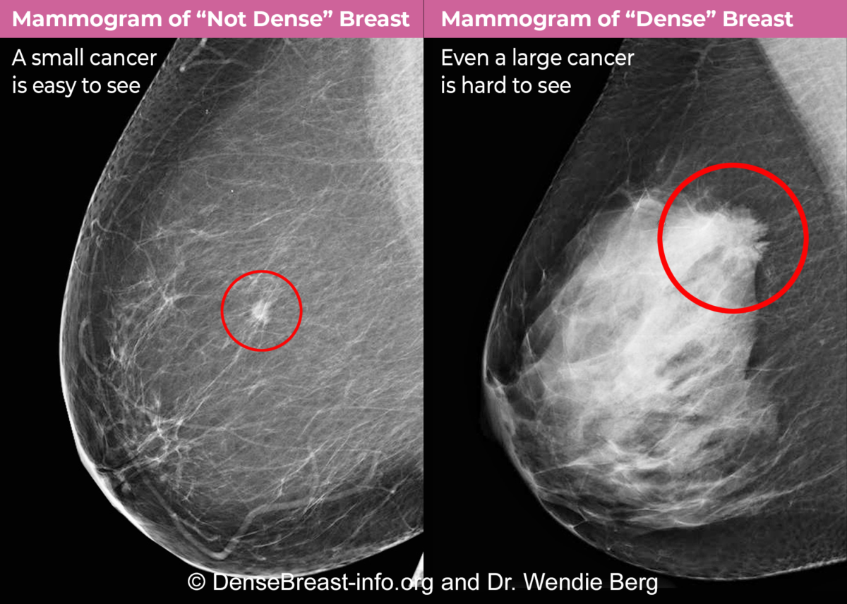 What does your breast density mean – Prevent Cancer Foundation